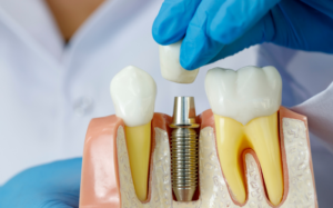 dental-implants Kitchener-Waterloo